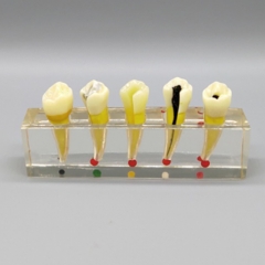 双尖牙透明根管病理牙 XZ-002