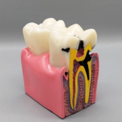 病理牙模型 XZ-020
